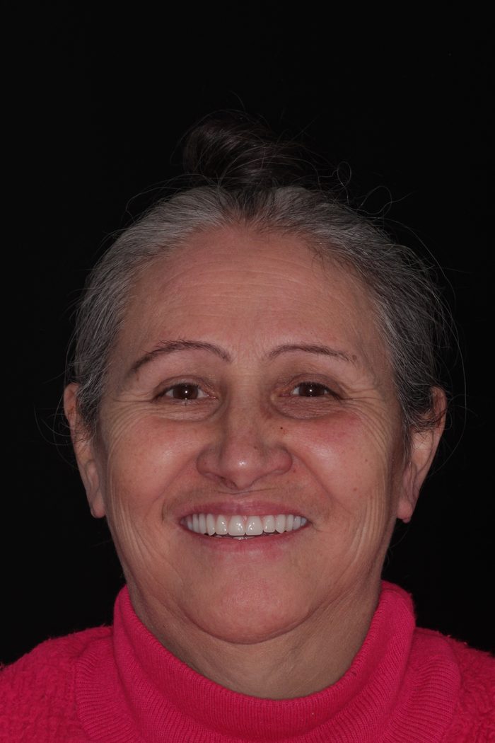 Paciente da Oral Unic Caçador sorrindo após a reabilitação com implantes